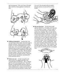 Emergency Childbirth Mini Guide | Birth & Women's Health Resource 25 Emergency Childbirth Mini Guide 12